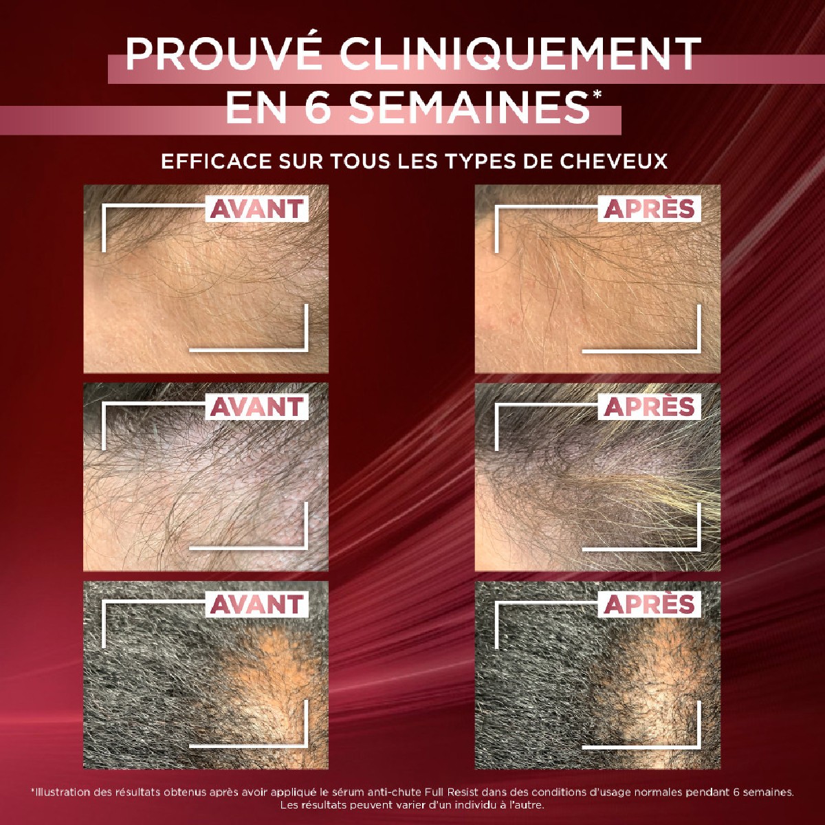 Sérums Anti-Chute Anti-Chute de cheveux 306mL couleur unique, L'OREAL PARIS